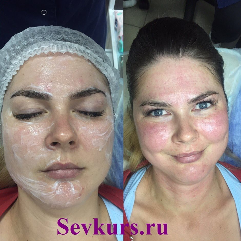 Процедура Плазмотерапия. До и после процедуры.