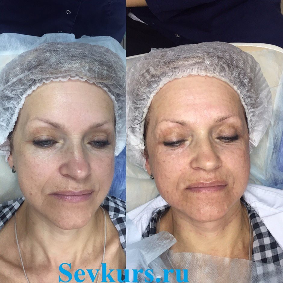 Биоревитализация. Демонстрационное занятие.